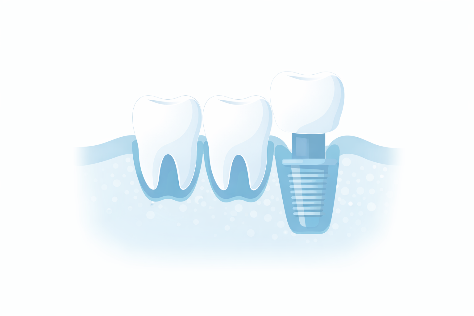Sostituzione denti mancanti